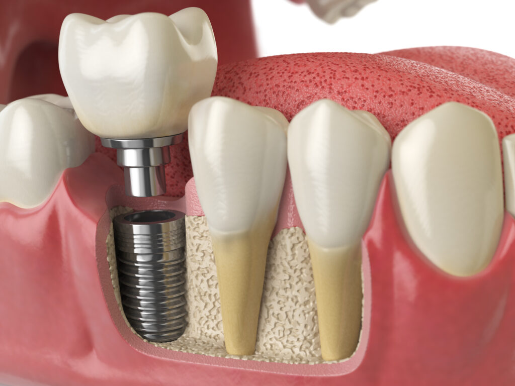 Dental Implants Dublin at Pearl Dental